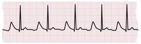 显示正常心率的心电图图